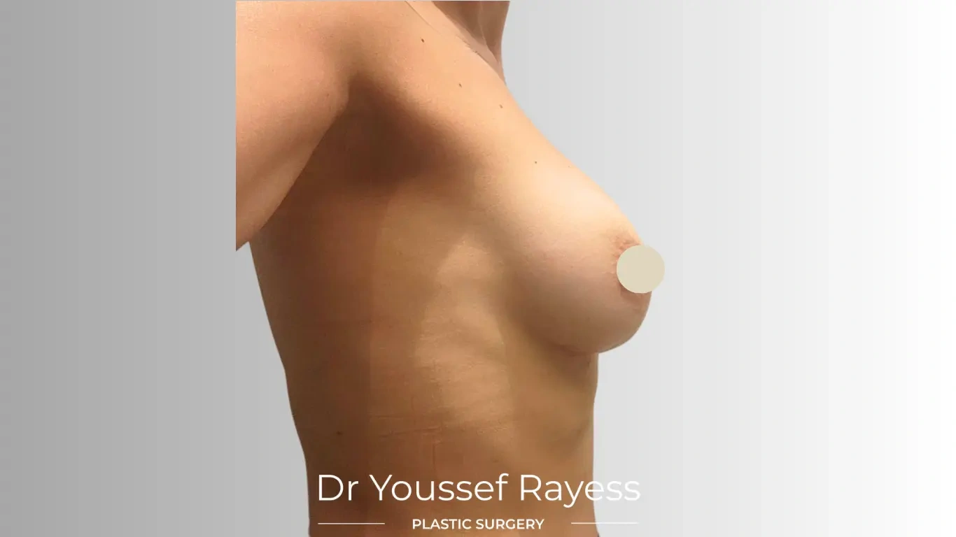 Right side view after breast augmentation surgery result by Dr Youssef Rayess in Beirut showing natural breast rejuvenation and harmony